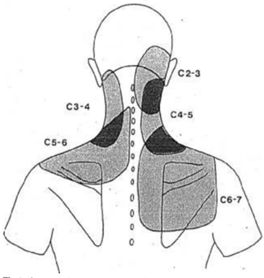 Mapa de dolor facetario cervical