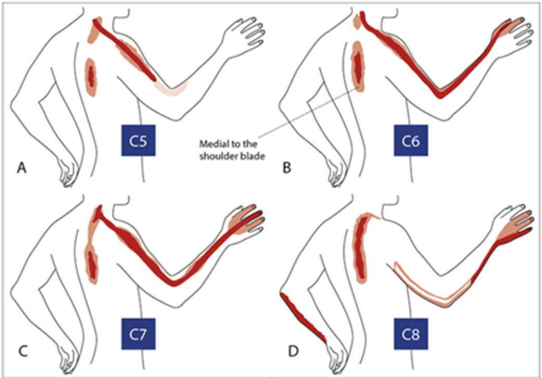 Mapa de dolor radicular cervical