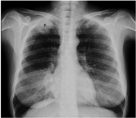 Radiografía de tórax compatible con síndrome de pancoast tobías