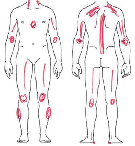 Body chart representando las áreas de dolor de una persona con fibromialgia