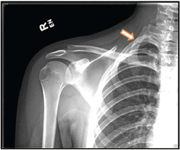 Radiografía de hombro-torax compatible con fractura de primera costilla